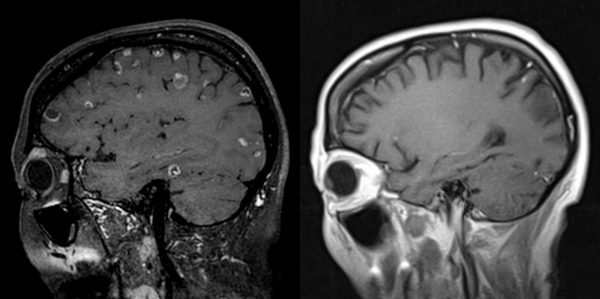 치료 전후 사진