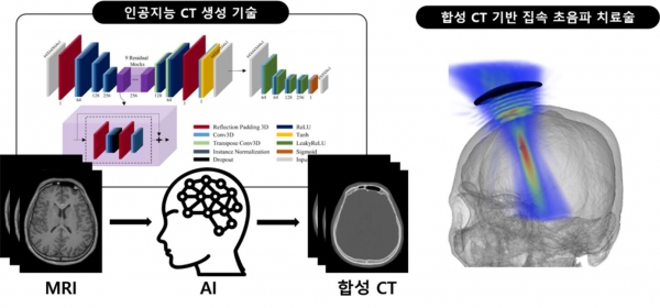 인공지능 합성 CT 기반 집속 초음파 치료술 모식도