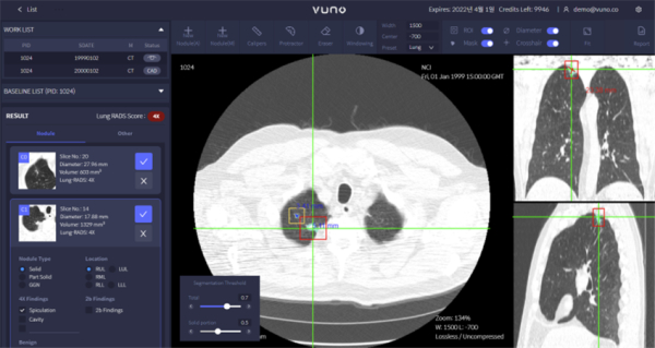 인공지능(AI) 판독보조시스템을 이용한 흉부CT 판독 영상(㈜VUNO MED_LungCT AI)