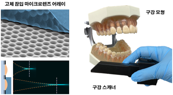 고체 잠입 마이크로렌즈 어레이 및 구강 스캐너와 구강 모형 사진