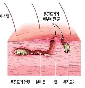피부질환 옴 진드기 감염병 관리 교육